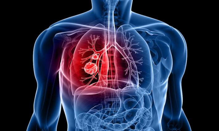 Graphic illustration of human anatomy showing lung cancer