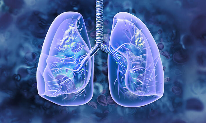 Graphic image showing lung nodules