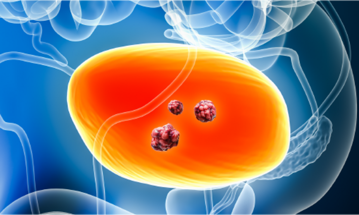 Anatomic graphic showing cancerous cells in the bladder