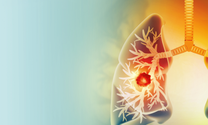 Medically accurate illustration of lung cancer. showing presence of cancerous tumor inside the lungs