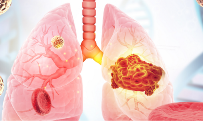 Conceptual 3D Illustration of Viral-Induced Lung Cancer