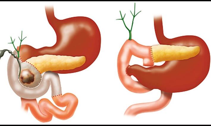 The Whipple procedure requires extensive surgical skill to safely remove the head of the pancreas; portions of the small intestine, bile duct, gallbladder, and stomach; and some lymph nodes.