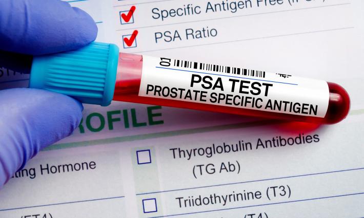 Test tube with prostate specific antigen test sample