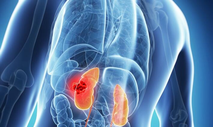 Kidney Cancer