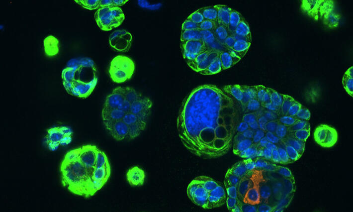 Basal cells lung cancer