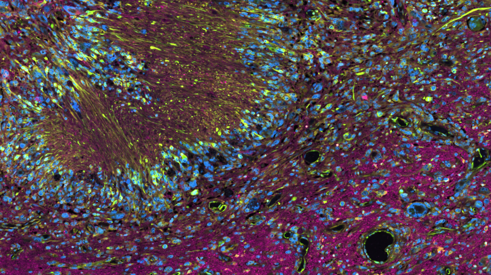 Image provided by Lauren Whaley – Glioblastoma multimodal staining data