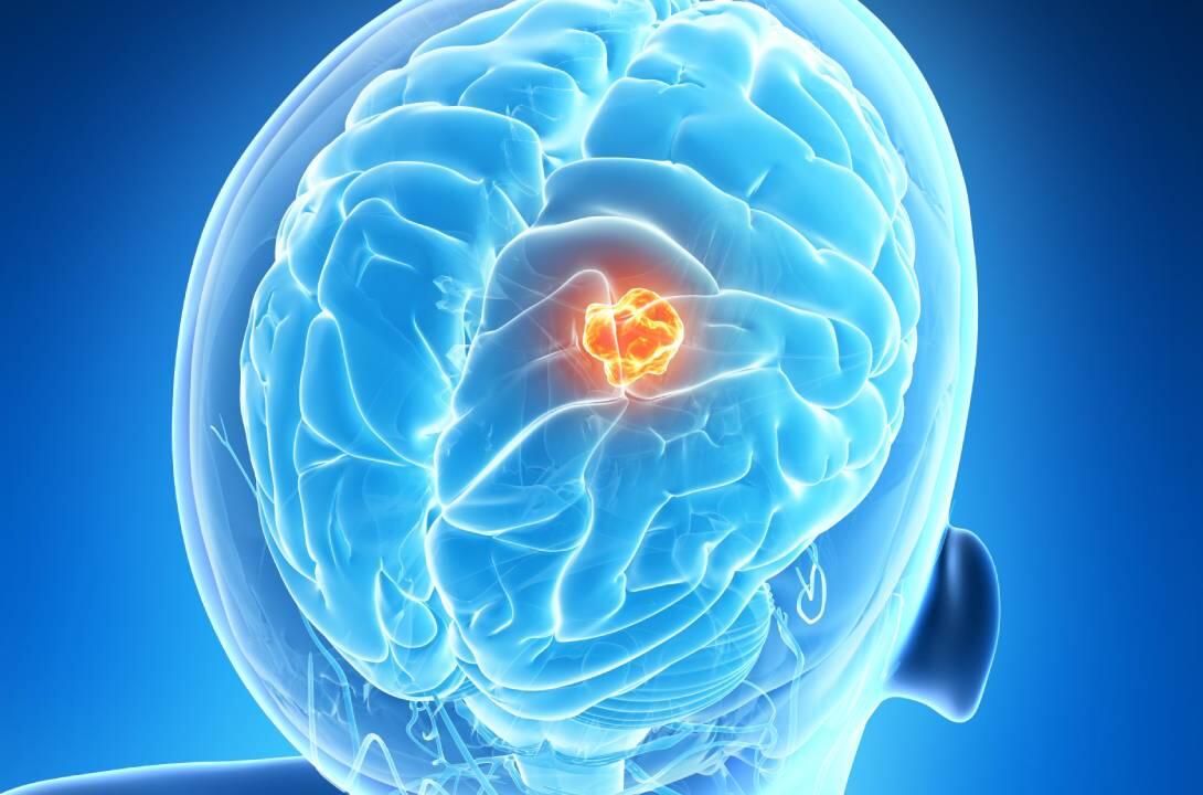 Brain with brain tumor