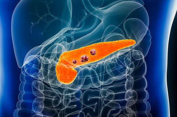 Pancreatic cancer tumor