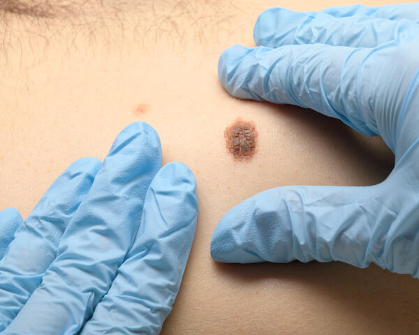 gloved hands look at mole