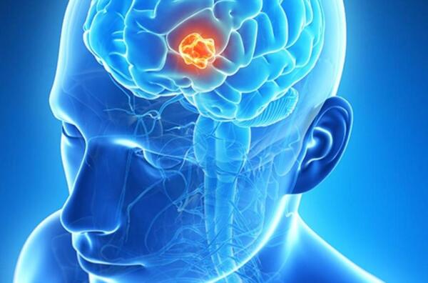 Brain tumor