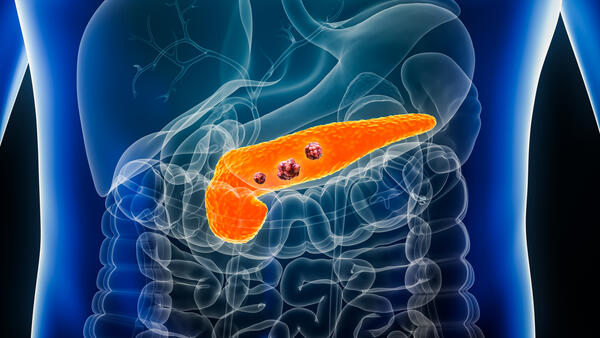 Pancreatic cancer tumor