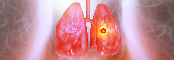 Medically accurate illustration of lung cancer