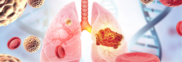 Conceptual 3D Illustration of Viral-Induced Lung Cancer