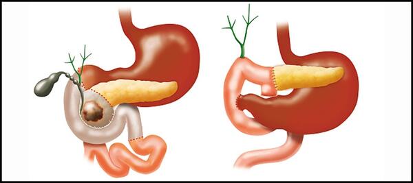 The Whipple procedure requires extensive surgical skill to safely remove the head of the pancreas; portions of the small intestine, bile duct, gallbladder, and stomach; and some lymph nodes.