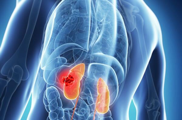 Kidney Cancer