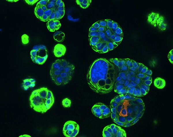 Basal cells lung cancer