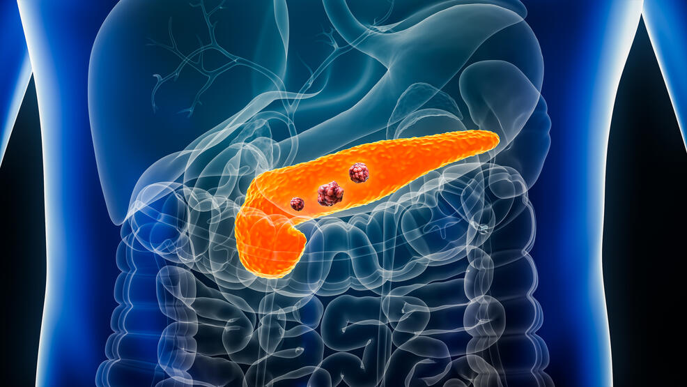 Pancreatic cancer tumor