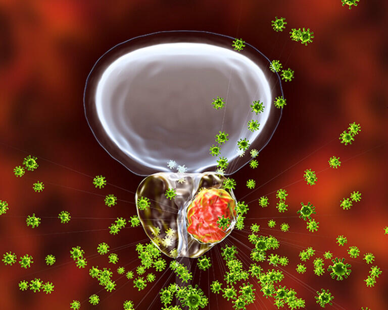 Prostate cancer image