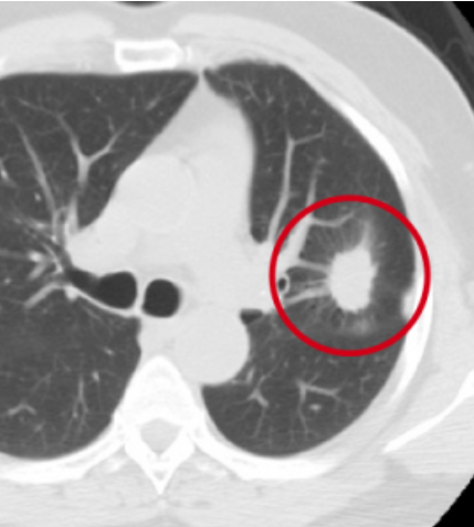 CT scan showing lung cancer
