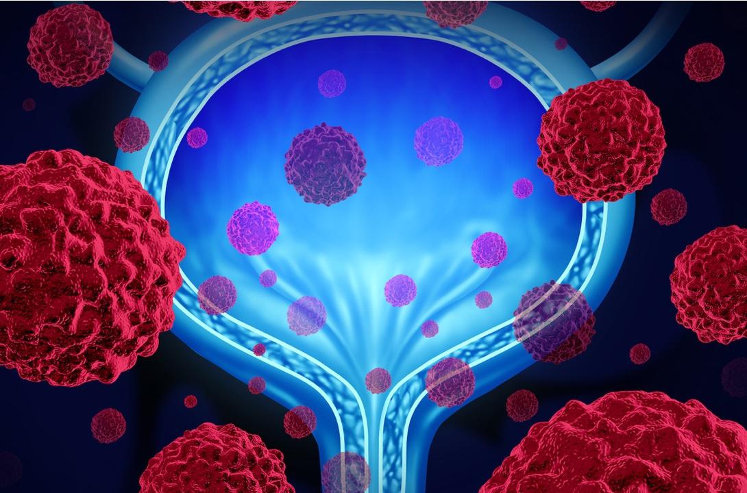 illustration of a bladder surrounded by cancer cells